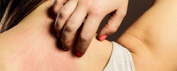 psoriasis